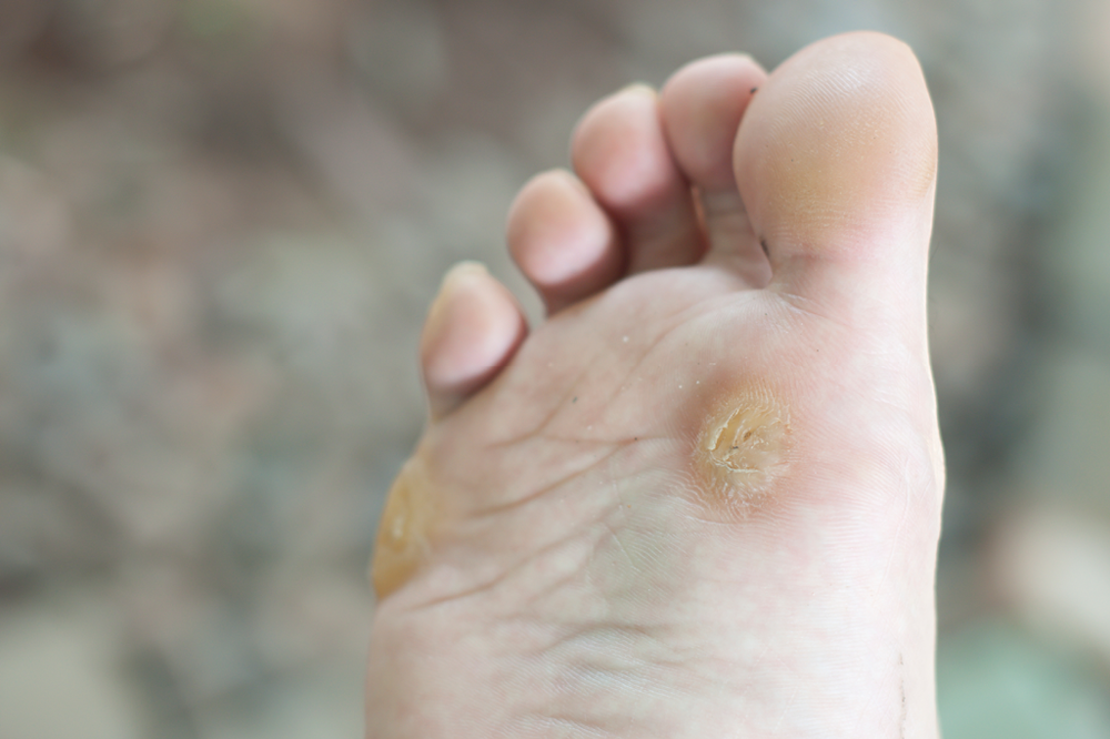 5 Quick Ways to Remove Hard Foot Skin 