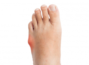 bone spur on outside of foot